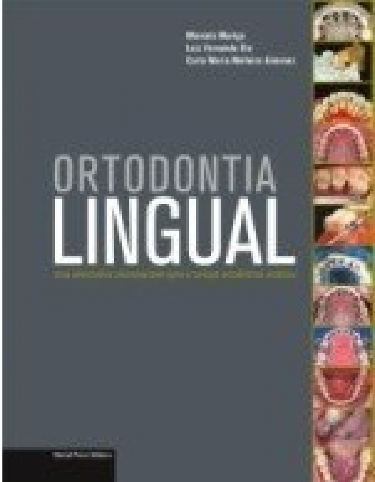 Ortodontia Lingual