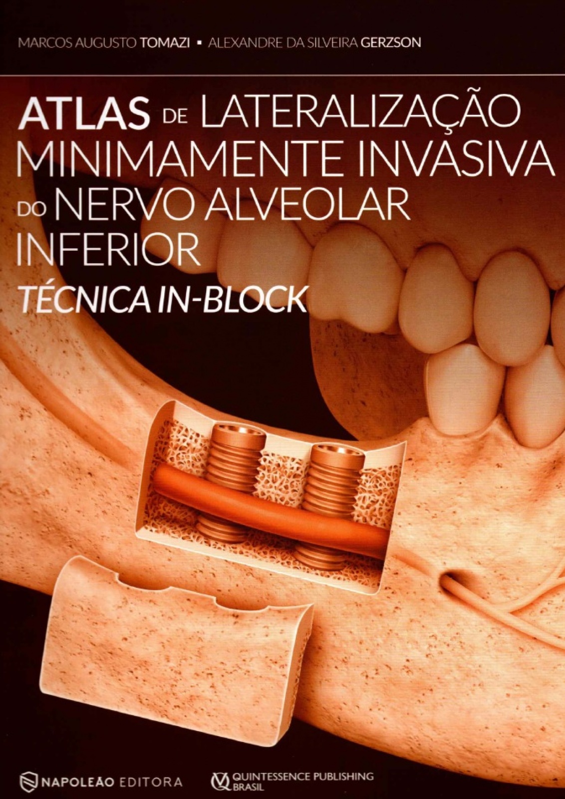 Atlas De Lateralização Minimamente Invasiva Do Nervo Alveolar Inferior. Técnica In-Block