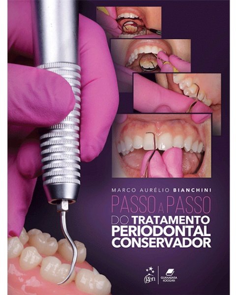 Passo A Passo Do Tratamento Periodontal Conservador