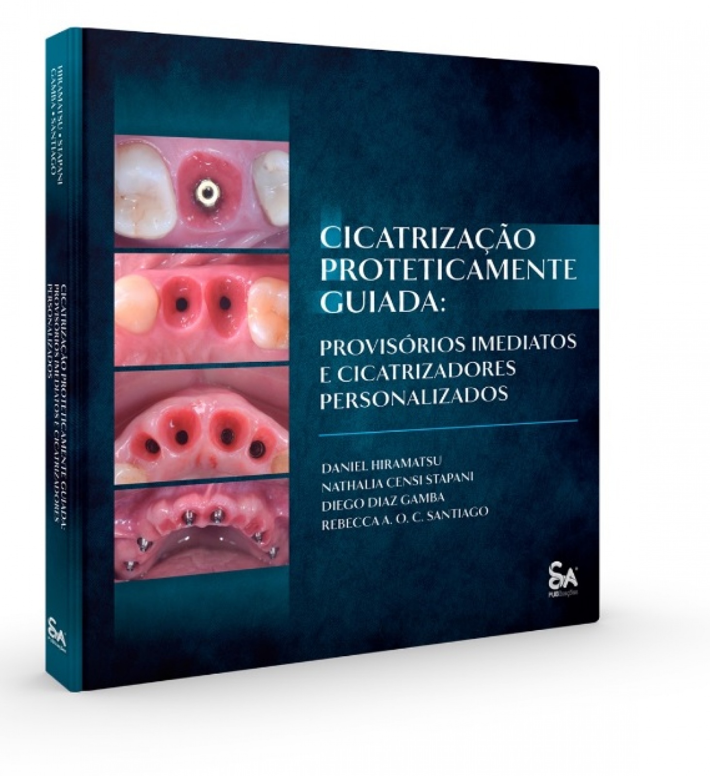 Cicatrização Proteticamente Guiada: Provisórios Imediatos E Cicatrizadores Personalizados